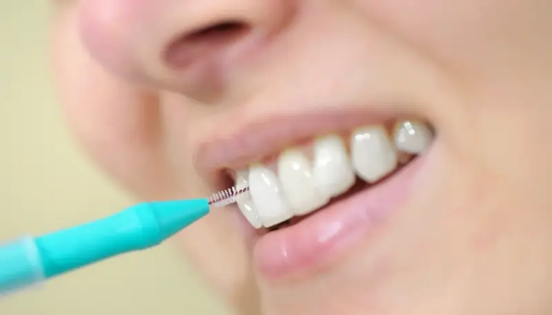 Wypełnianie zęba, plombowanie