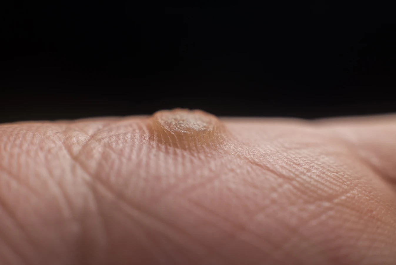 Jak wygląda rdzeń kurzajki?